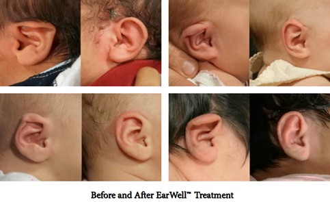 earwell treatment before and after in infants 
